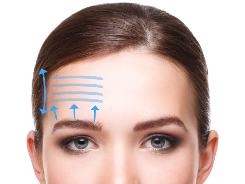 lifting frontal tunisie